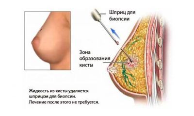 Как выполняется пункционная биопсия?