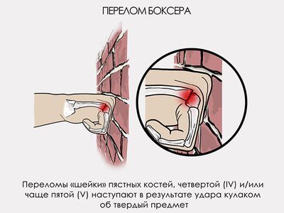Травма боксера