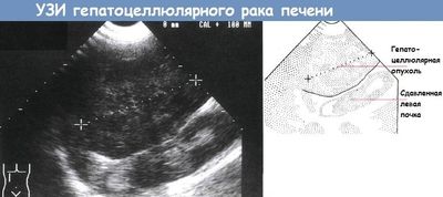 УЗИ гепатоцеллюлярного рака