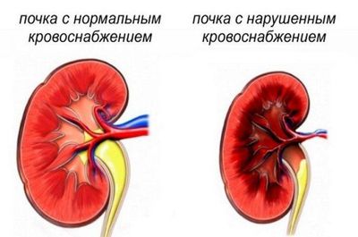 Тромбоз почечных артерий