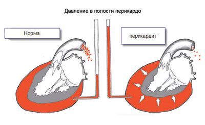 Перикардит