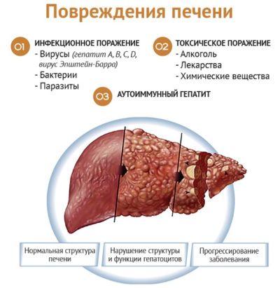 Причины цирроза печени