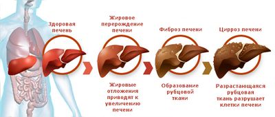 Стадии цирроза