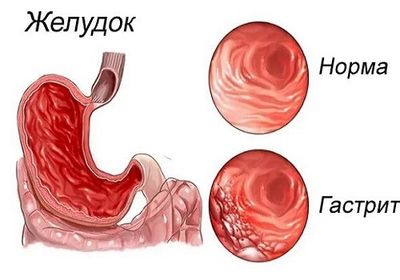 Гастрит