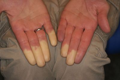 Склеродермия сосудов и сердца