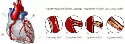 артерии при ишемии