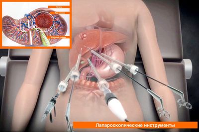 Лапароскопия