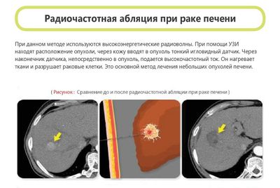Радиочастотная абляция