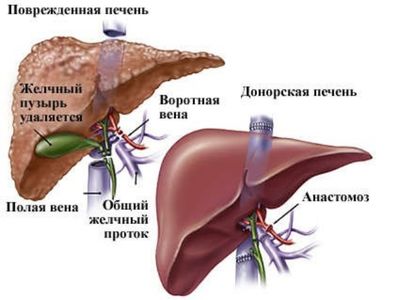 Пересадка