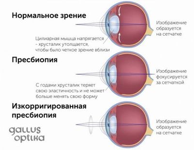 пресбиопия