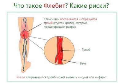 Флебит
