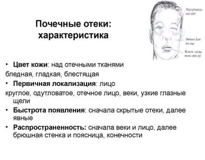 Почечные отеки