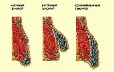 Комбинированный геморрой