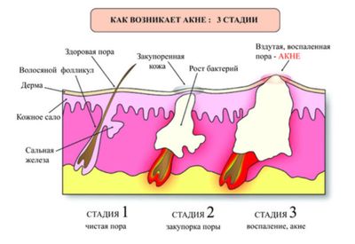 Механизм развития акне