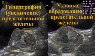 образования на предстательной железе