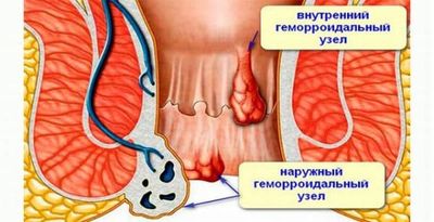 Геморрой