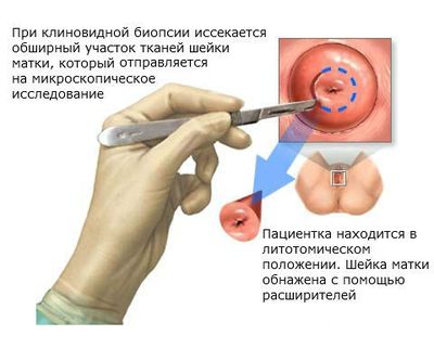 Процедура клиновидной биопсии