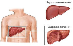 Возможный исход при вирусном гепатите
