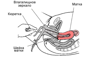 Выскабливание полости матки