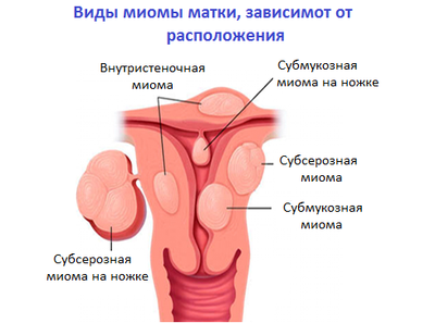 Выскабливание полости матки