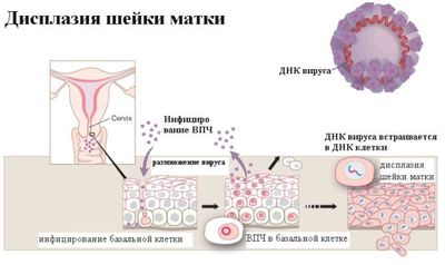 Дисплазия шейки матки