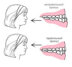 Неправильный прикус